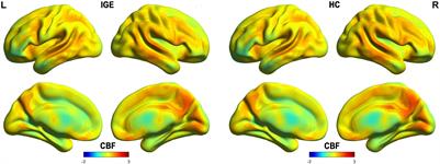 Alterations of cerebral perfusion and functional connectivity in children with idiopathic generalized epilepsy